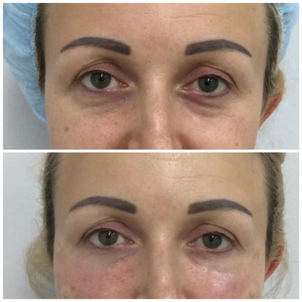 Lipofilling - efekty