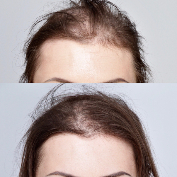 Mezoterapia skóry głowy: przed i po