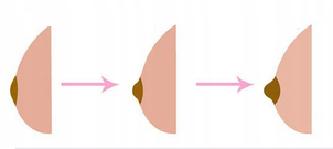 Korekcja wciągniętych brodawek