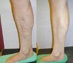 Usuwanie żylaków laserem