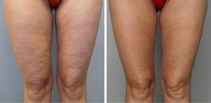 Efekty HIFU na udach