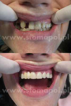 Metamorfoza uśmiechu - implanty