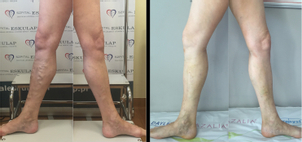 Klejenie żylaków – efekty