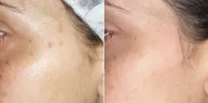 Peeling chemiczny – przed i po