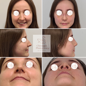 Korekta nosa: przed i po