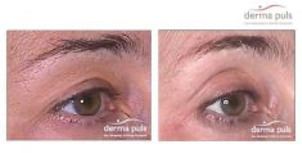 Termolifting - przed i po