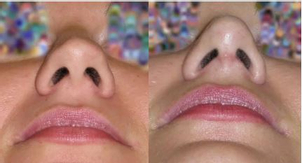 Blizna po korekcji nosa