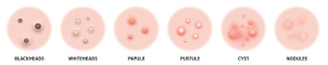 Rodzaje trądziku
