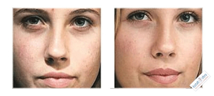 Mikrodermabrazja  – przed i po