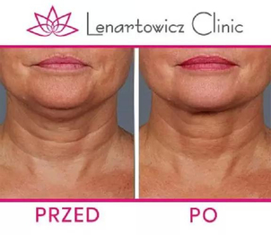 Lipoliza iniekcyjna podbródka