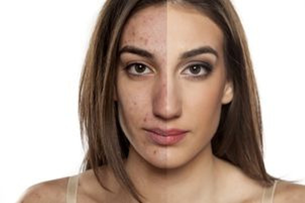 Laserowe zabiegi dermatologii estetycznej
