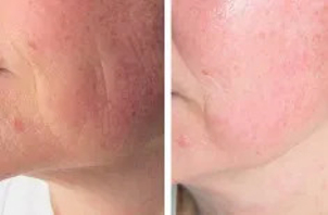 Zabieg radiofrekwencji twarzy - efekty