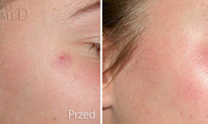 Zamykanie rozszerzonych naczynek IPL