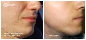 Laserowe usuwanie blizn potrądzikowych