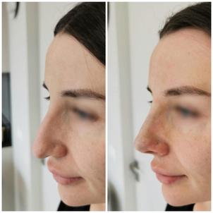 Nici liftingujące - modelowanie nosa