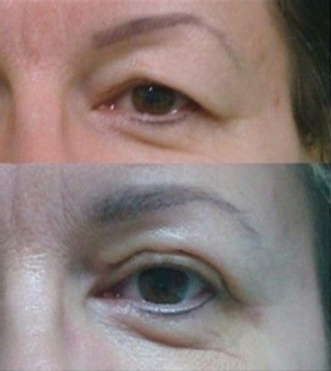 Bleafroplastyka - przed i po