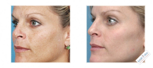 Fototerapia - przed i po