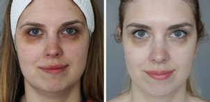 Usuwanie cieni pod oczami IPL