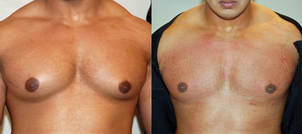 Efekty korekty ginekomastii