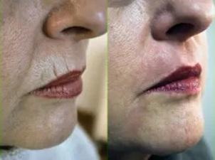 Efekty laserowych zabiegów odmładzających