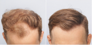 Przeszczep włosów efekty