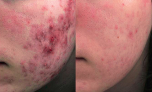 Efekty terapii przeciwtrądzikowej