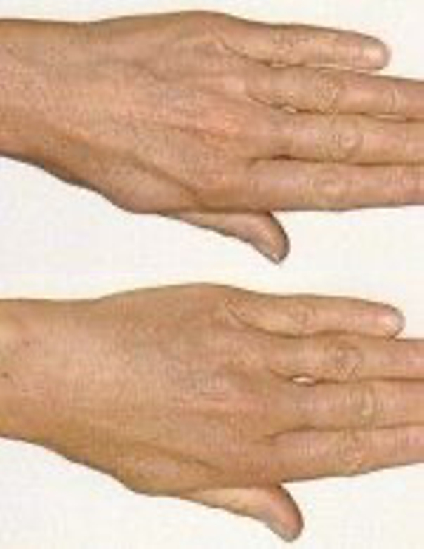Mezoterapia pozwala odmłodzić dłonie (Bona Dea)