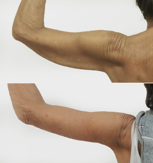 Lifting ramion - efekty