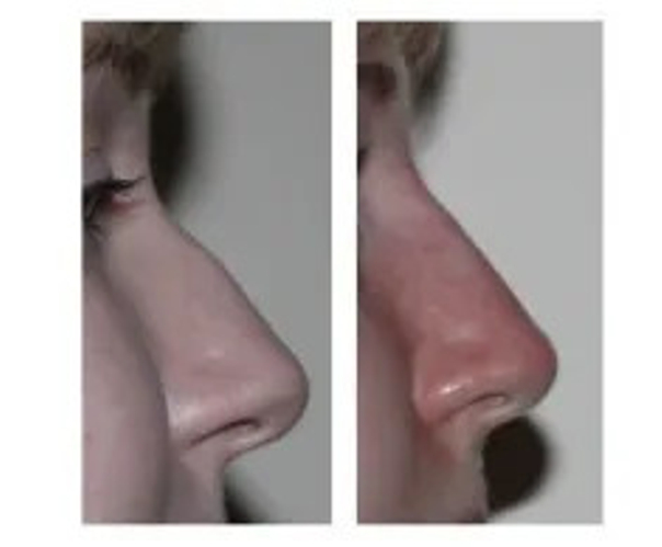 Korekta garbka na nosie kwasem hialuronowym - efekty