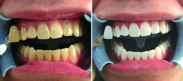 Wybielanie zębów: przed i po
