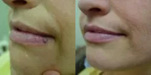 Usuwanie naczyniakow - przed i po