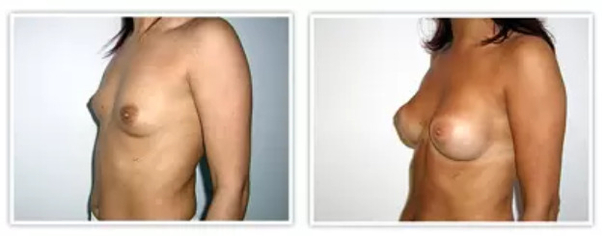 Implanty piersi - okrągłe i anatomiczne