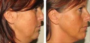 RF na podwójny podbródek