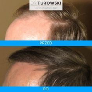 Efekty terapii łysienia