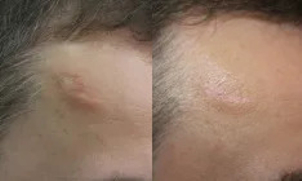 Efekt laserowego usuwania blizny