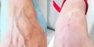 Kwas hialuronowy: odmładzanie dłoni