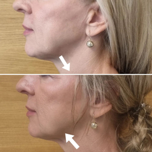 Nici liftingujące - efekty