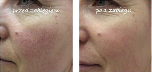 Laserowe usuwanie rumienia