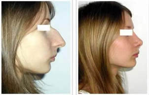 Korekcja nosa - przed i po