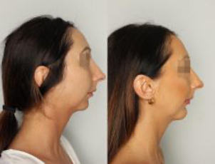 Plastyka brody: przed i po