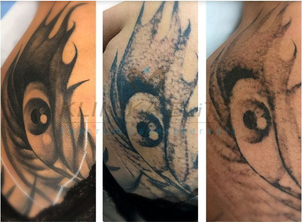 Laserowe usuwanie tatuażu