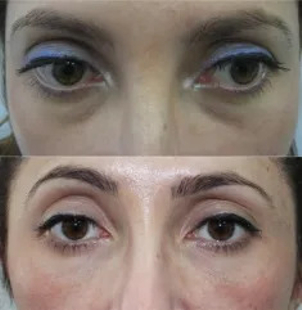 Wypełnianie doliny łez kwasem hialuronowym