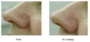 Zamykanie naczynek przed i po