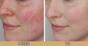 Mikrodermabrazja - przed i po