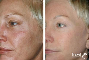 Laserowa odmładzanie przed i po