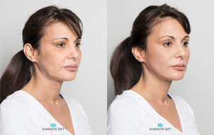 Nici liftingujące efekty