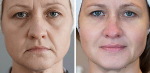 Przeszczep tłuszczu w obrębie twarzy - efekty