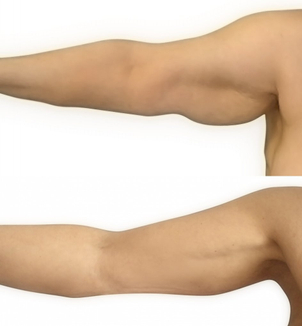 Lifting ramion - efekty