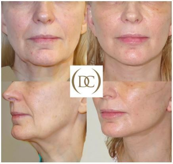 Lifting twarzy powoduje wzrost napięcia skóry, poprawienie owalu twarzy, wygładzenie zmarszczek, wymodelowanie i korektę rysów twarzy - dr Piotr Osuch