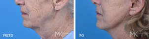 Lifting twarzy powoduje wzrost napięcia skóry, poprawienie owalu twarzy, wygładzenie zmarszczek, wymodelowanie i korektę rysów twarzy - dr Piotr Osuch